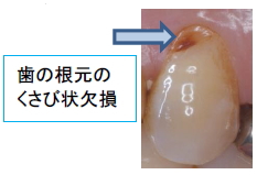 歯の根元の くさび状欠損