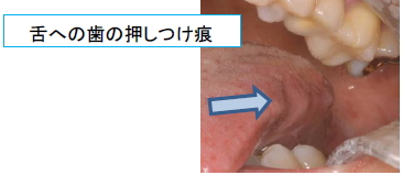 舌への歯の押しつけ跡