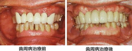 歯周病の治療前と後