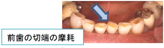 前歯の切端の摩耗